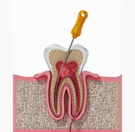 root canal