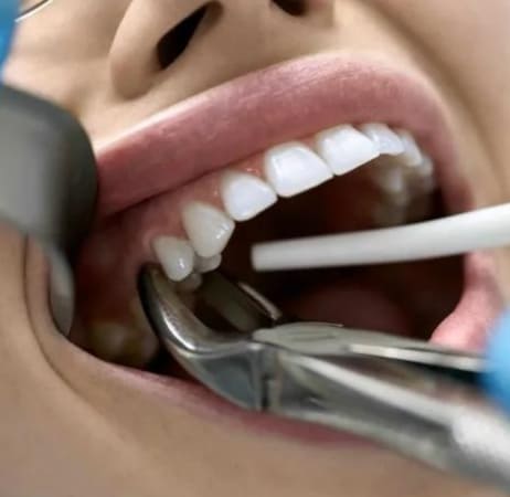 teeth extraction