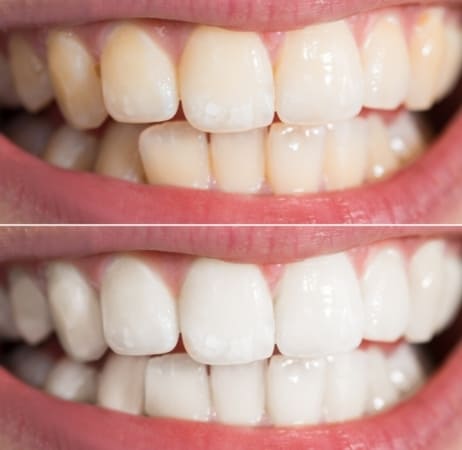 teeth bleaching